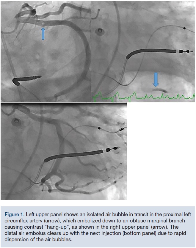 Coronary Artery Air Embolism What to Look Out For and How to Treat It